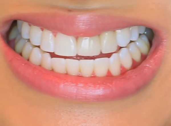 A fogfeh&eacute;r&iacute;t&eacute;st &eacute;s a fogkőleszed&eacute;st is b&iacute;zhatjuk dent&aacute;lhigi&eacute;nikusra