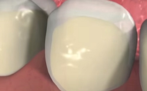 Komoly szerepet kaptak az őssejtek a fog körüli betegségek visszafordításában