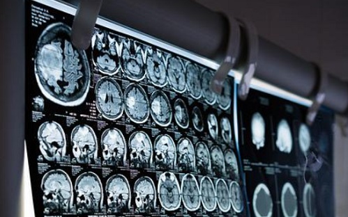 Agydaganatok esélyét mutatja meg a mesterséges intelligencia - és nem is drága
